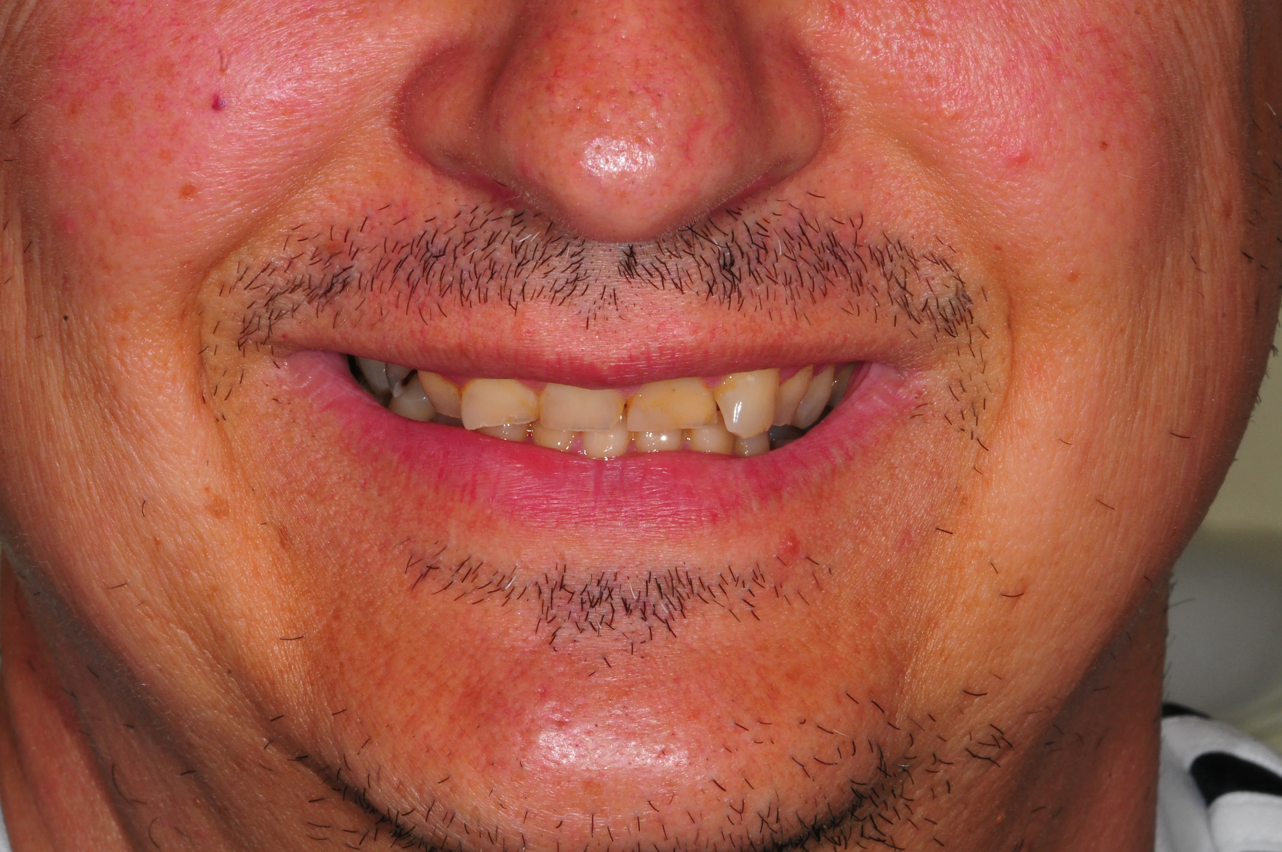 Antes - Coronas dentales