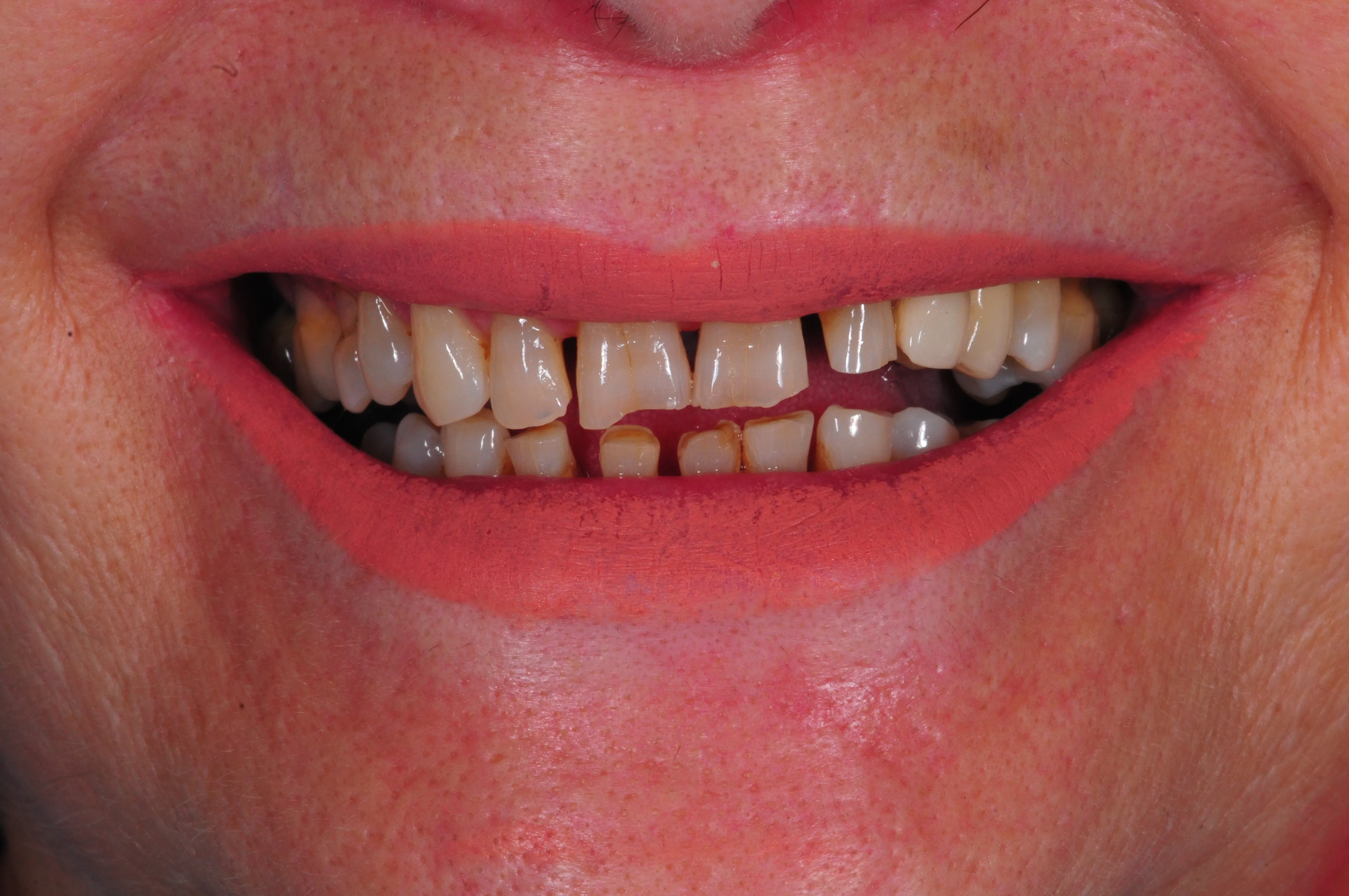 Antes - Coronas de circonio