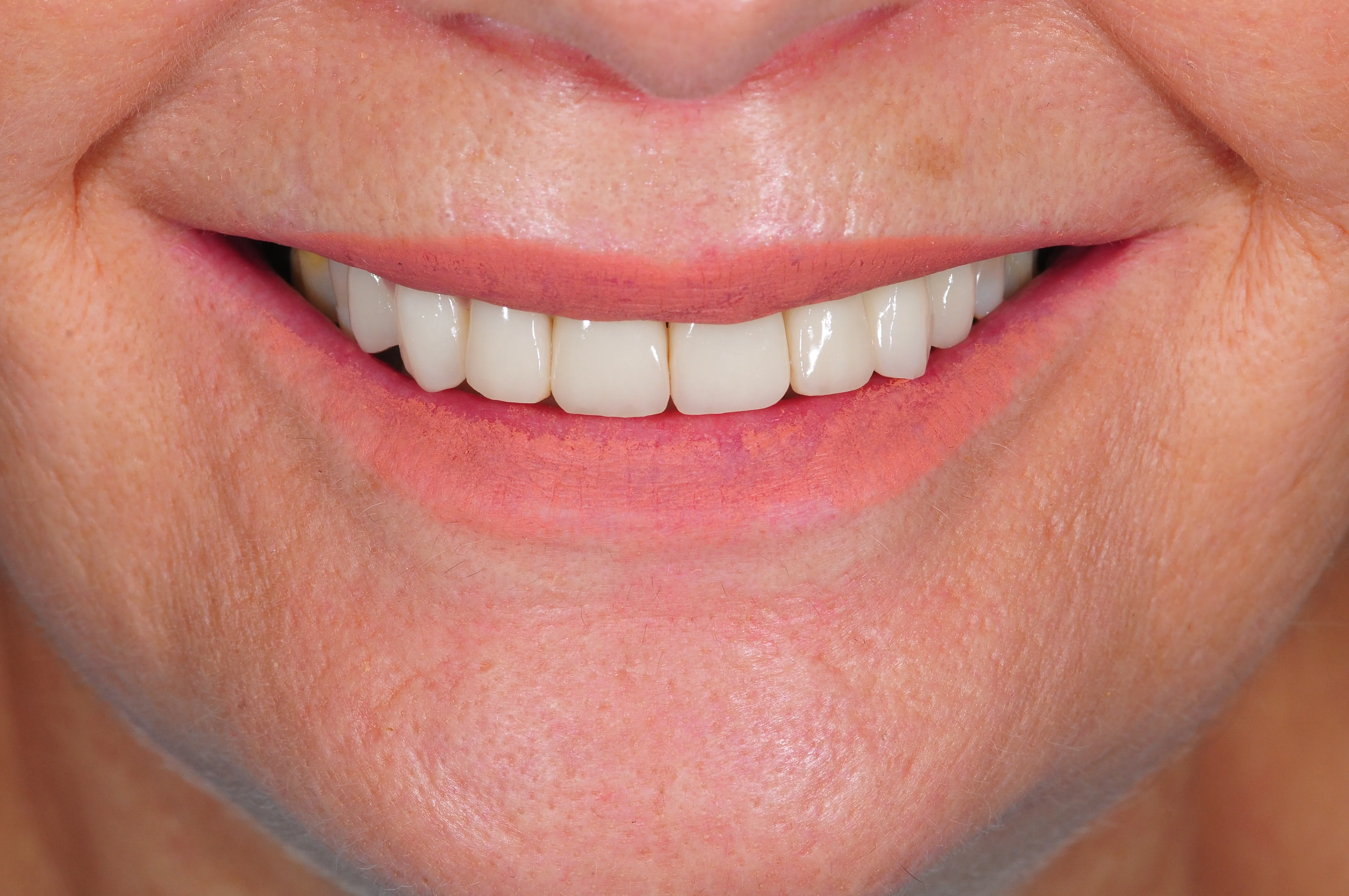 Después - Coronas de circonio