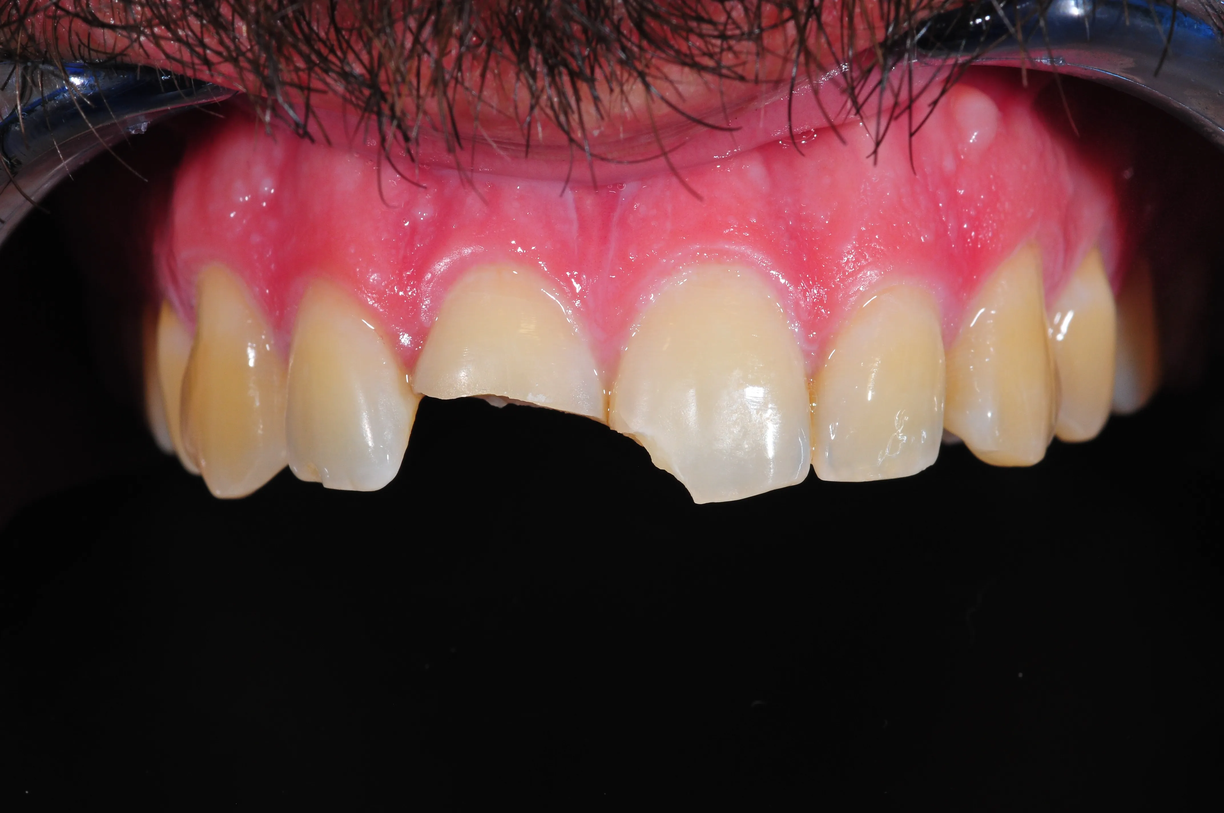 Antes - Fractura dental