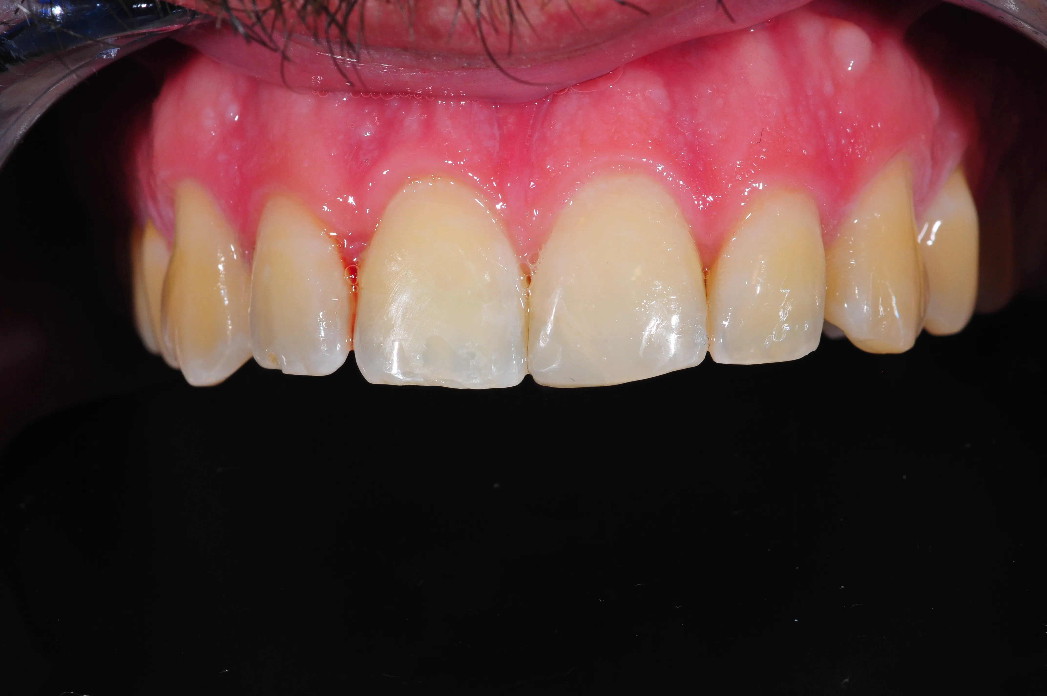 Después - Fractura dental