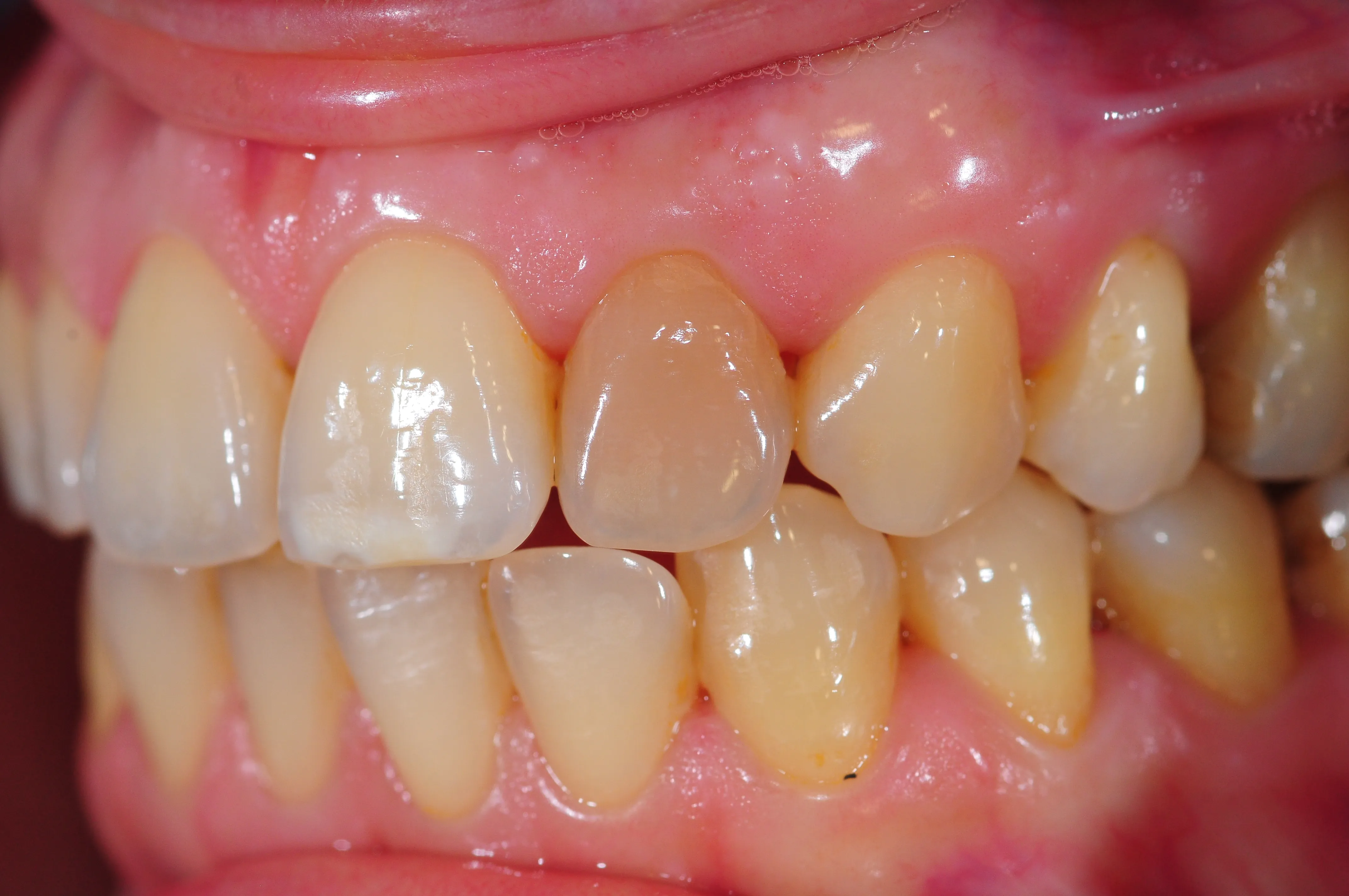 Antes - Blanqueamiento diente no vital