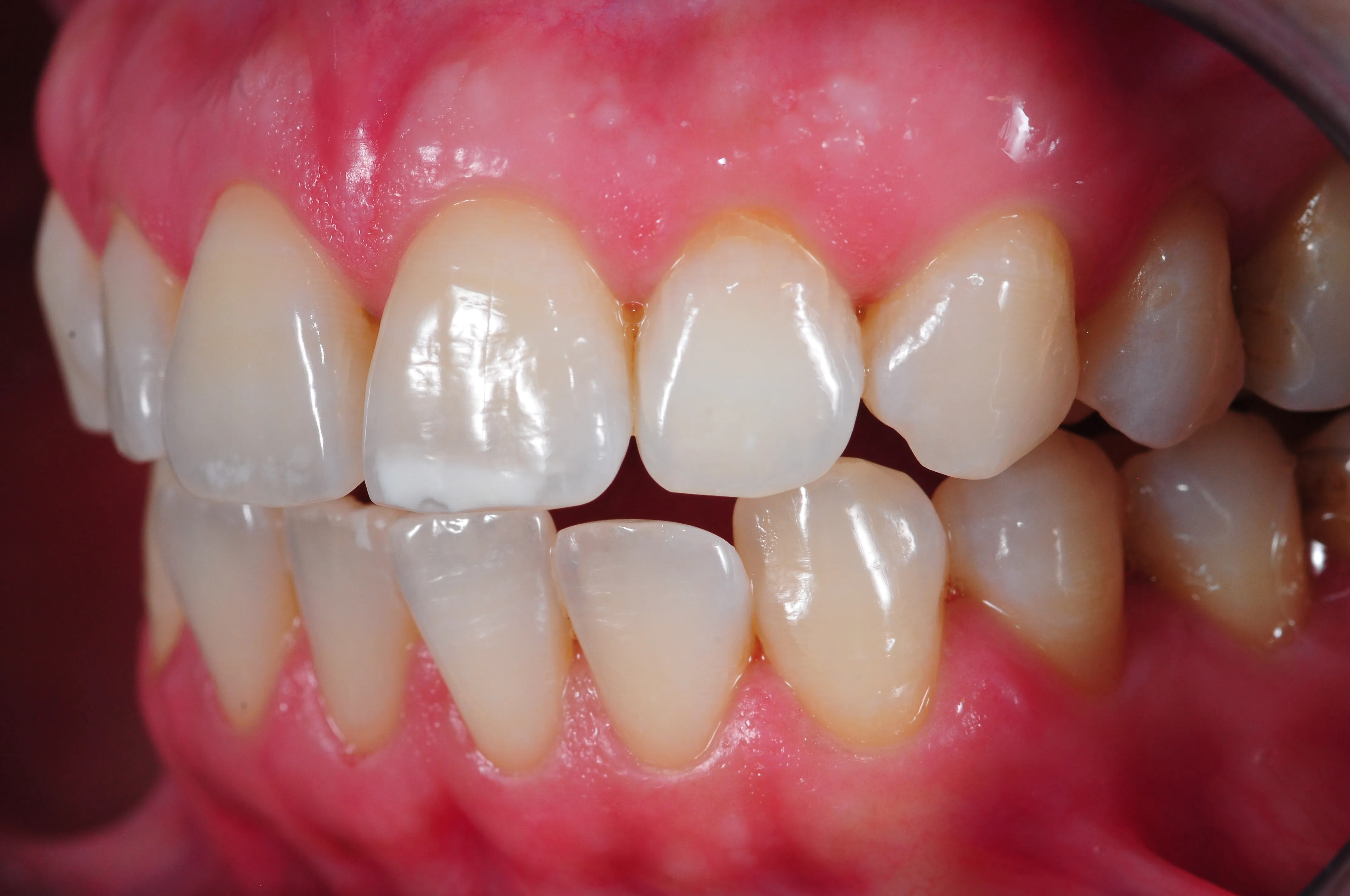 Después - Blanqueamiento diente no vital