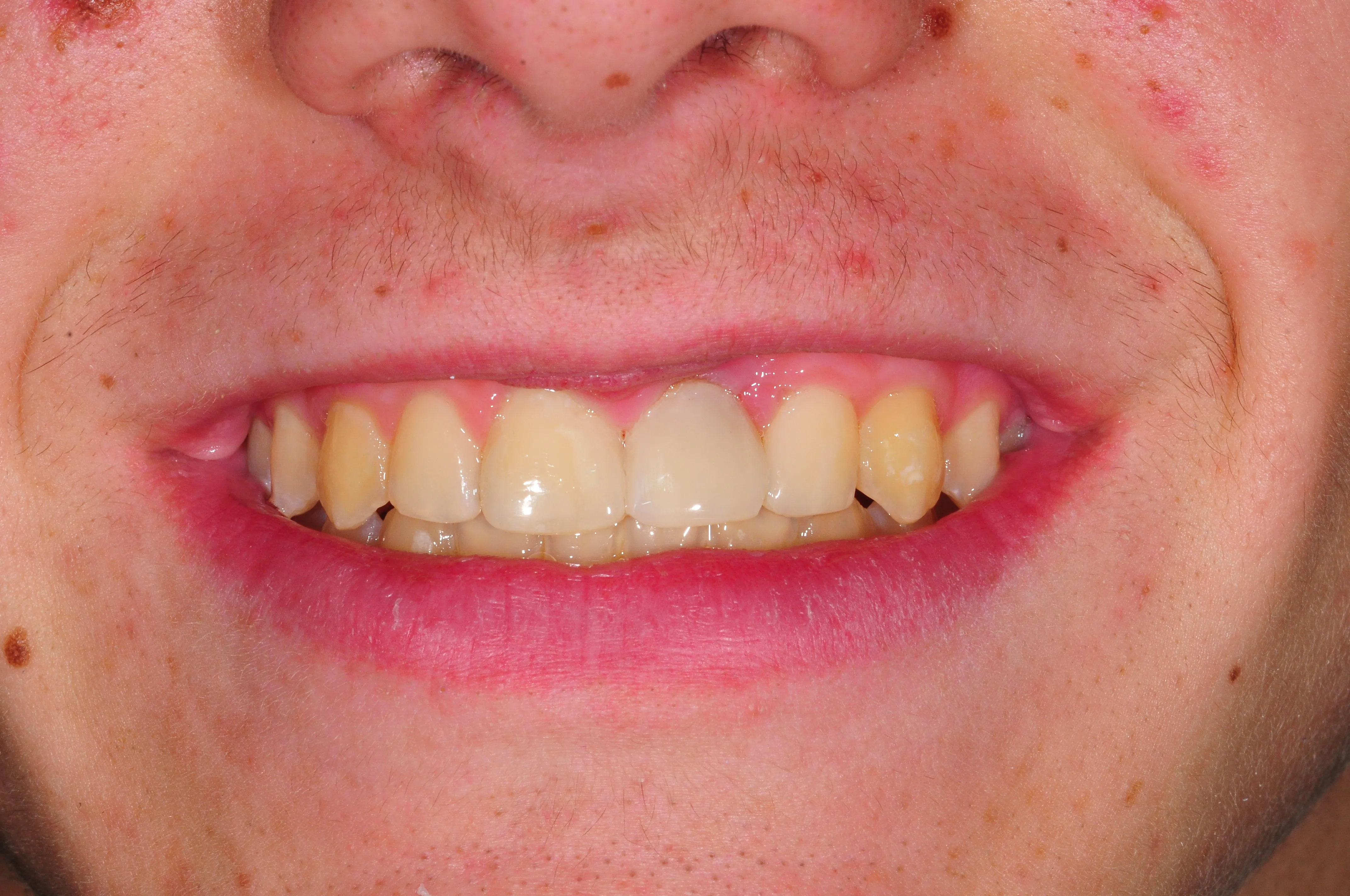 Después - Caso complejo rehabilitación oral