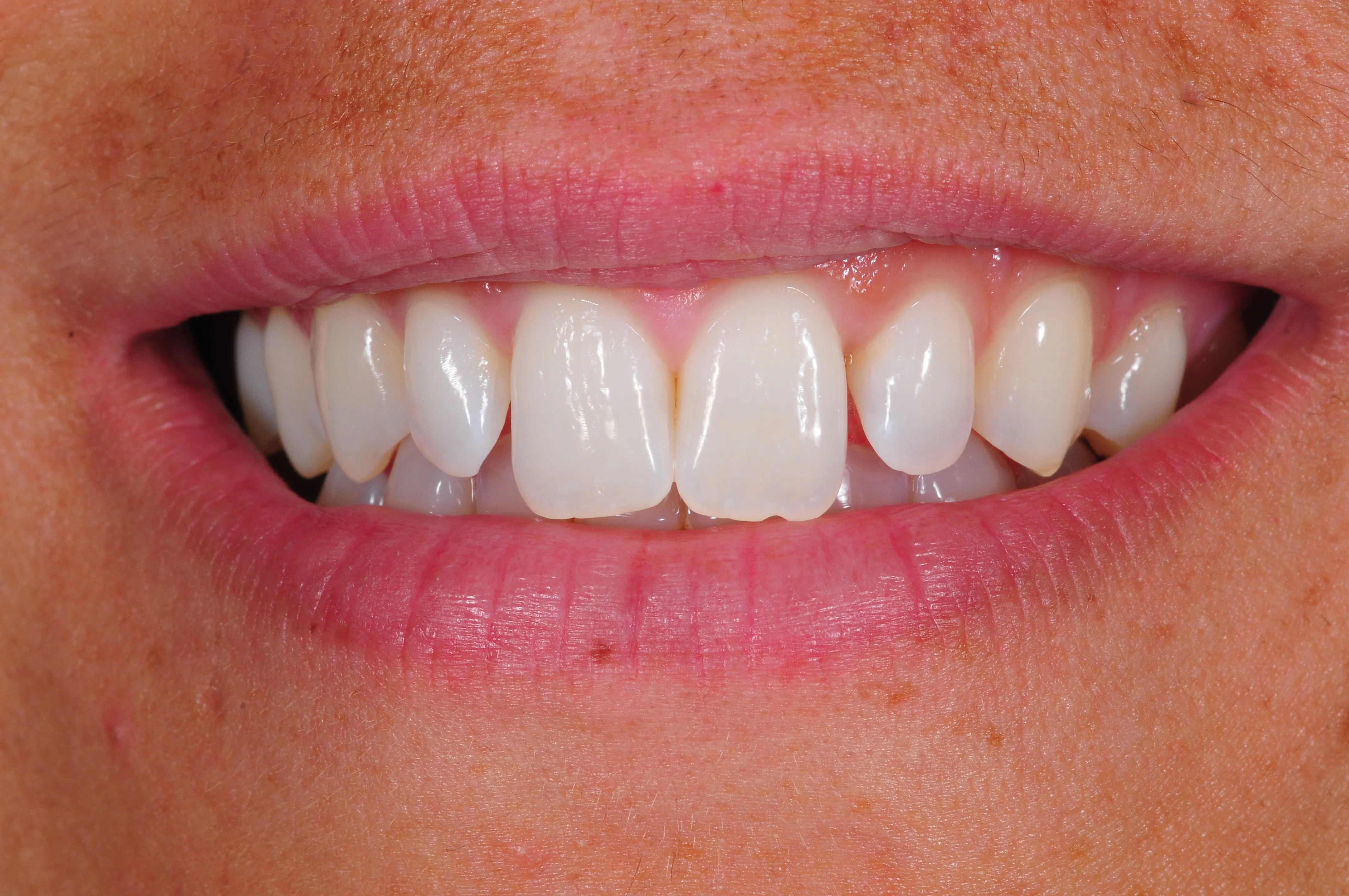 Antes - Cierre de diastema