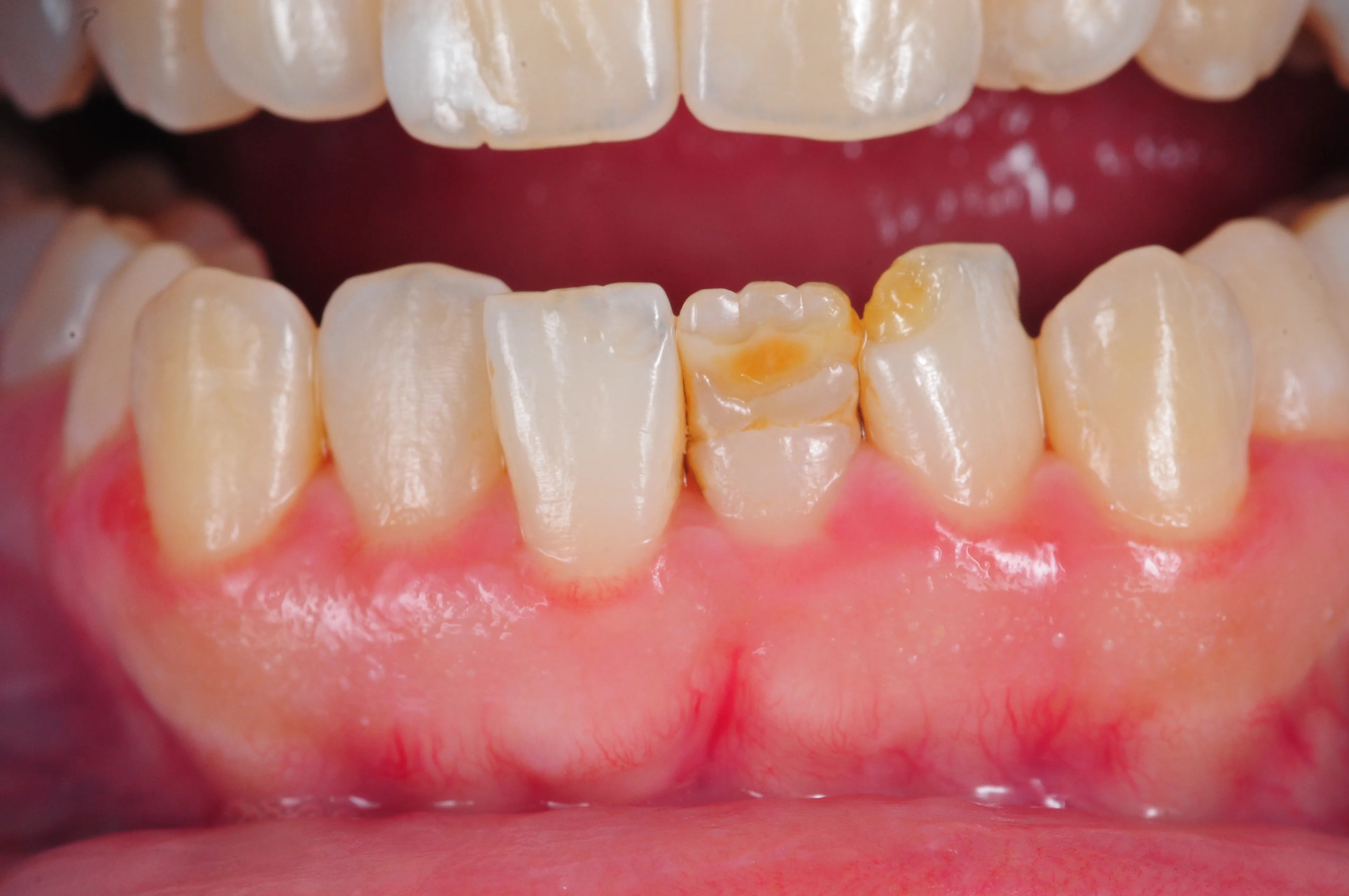 Antes - Reconstrucción estética