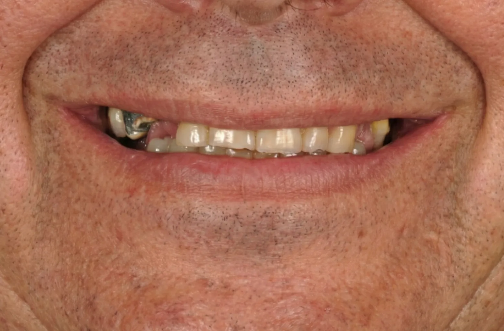 Antes - Rehabilitación oral