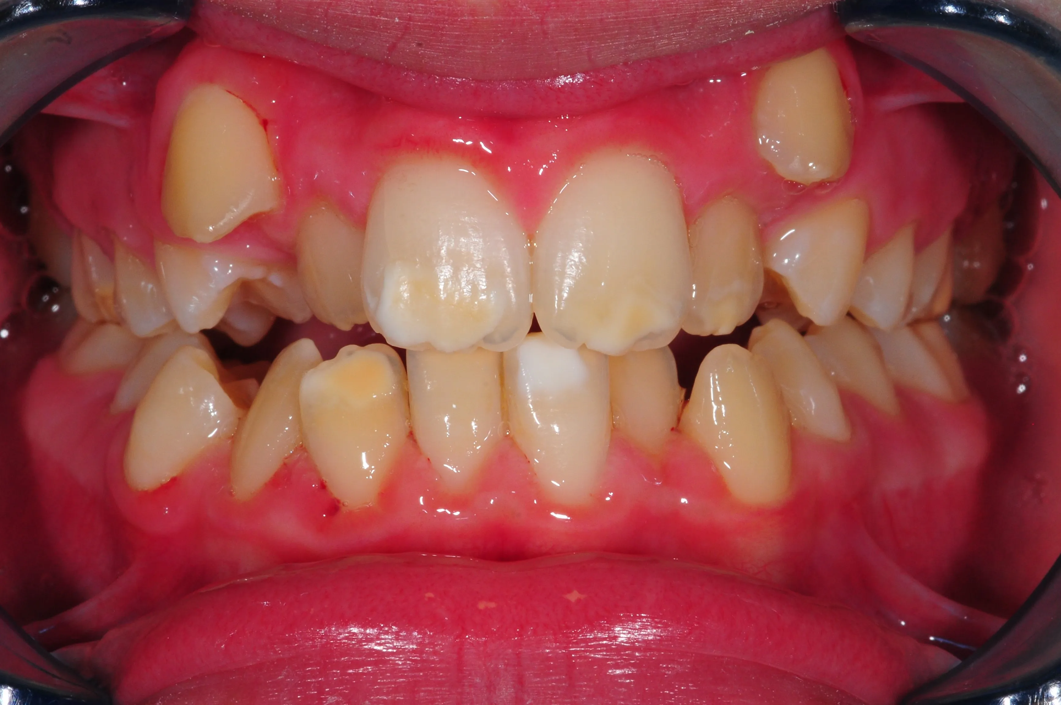 Antes - Alineadores SPARK